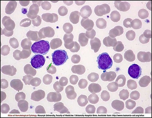Marginal zone lymphoma | Image: Atlas of Hematological Cytology