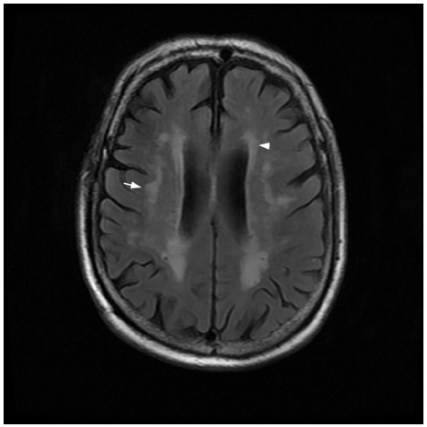 Results: White Matter Hyperintensities Can Be Predictive Marker in Early Stage Parkinson Disease 