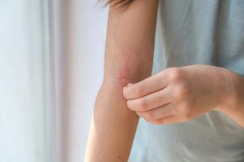 The apparent divergence between subjective and objective measures of atopic dermatitis severity underscores the need for more precise assessment methods, the authors explained. | Image credit: Evgeniya Primavera - stock.adobe.com