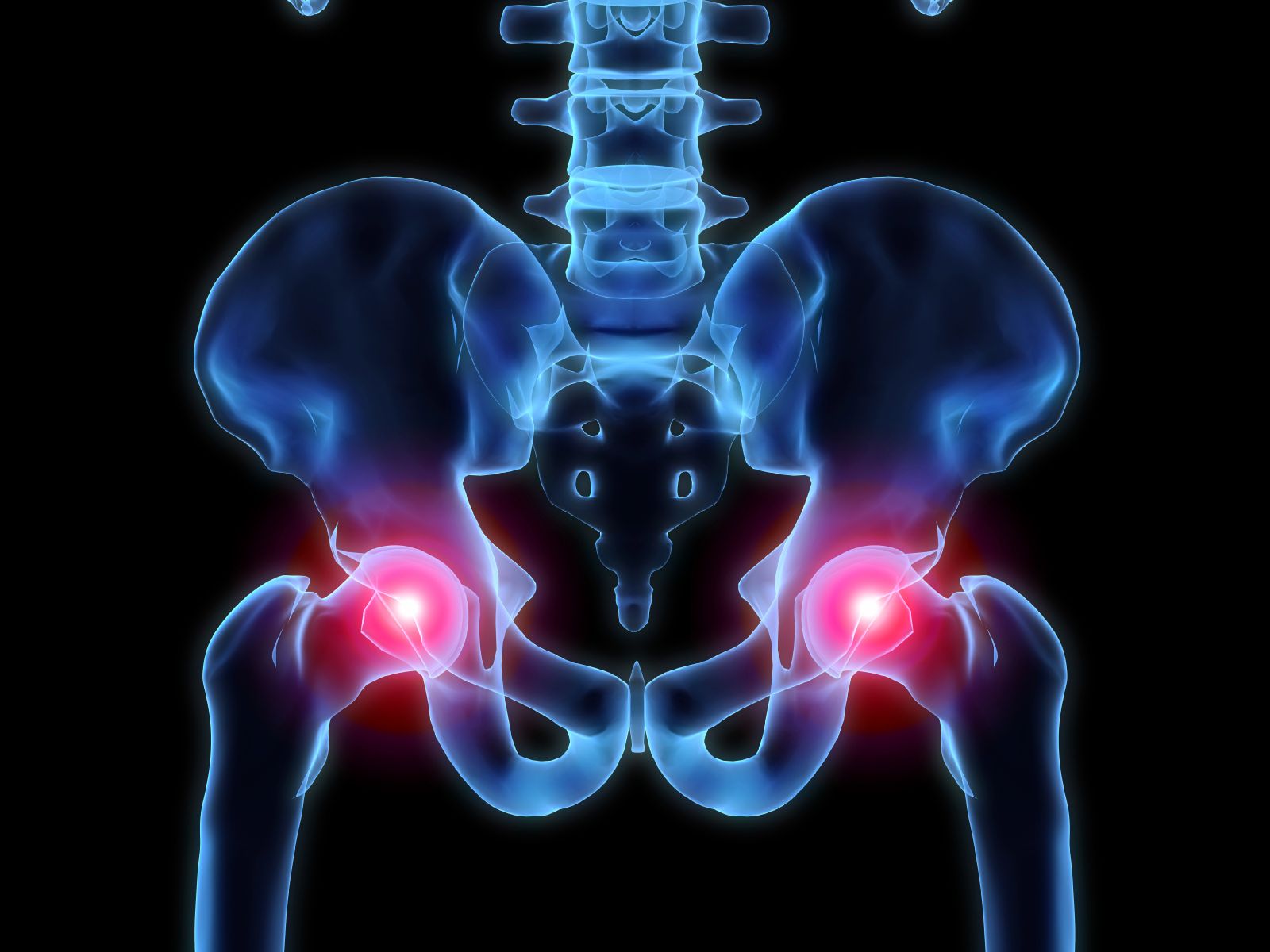  Hip Instability Progresses Most Rapidly in Patients With SMA Type 1