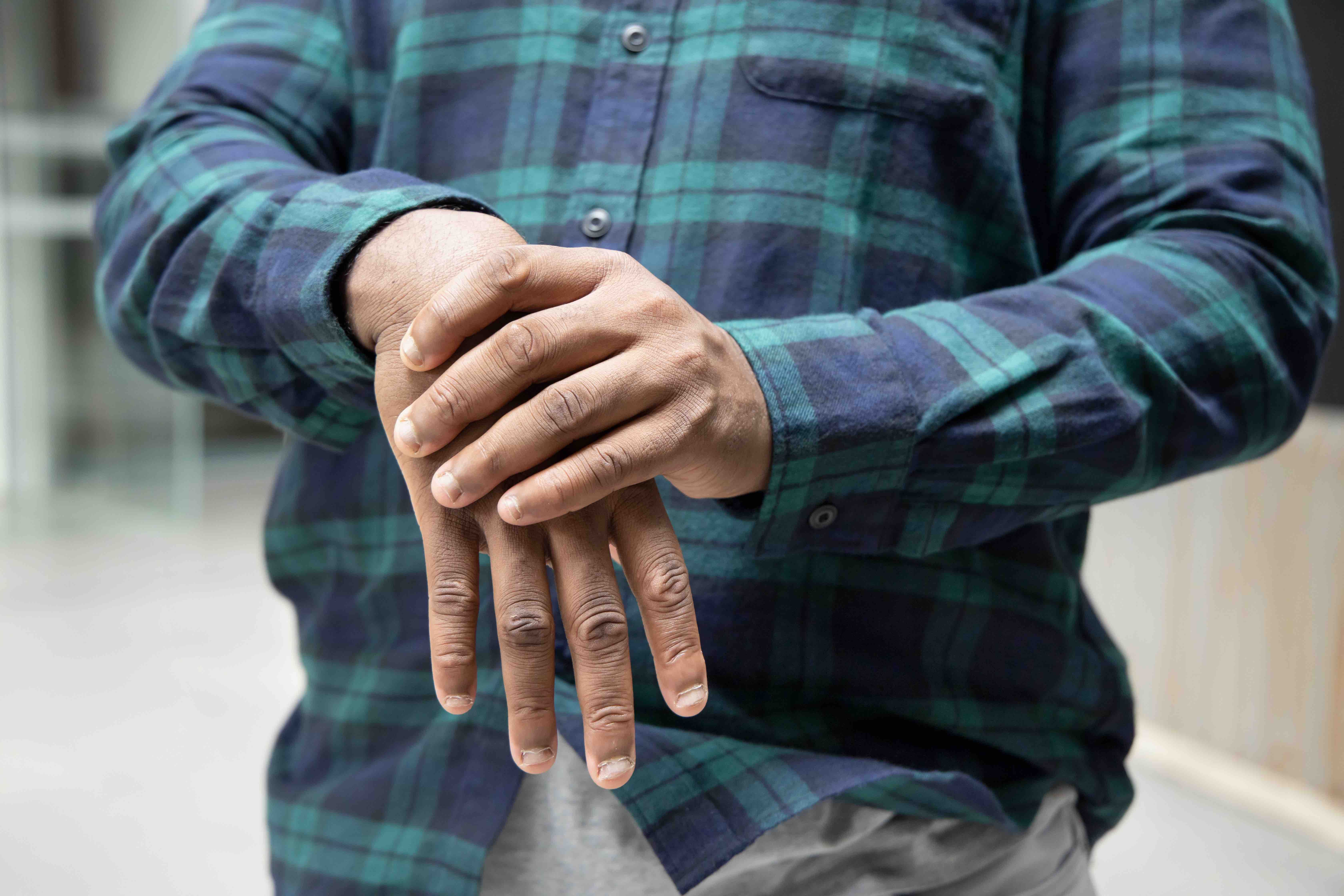 Obesity was linked with worse patient-reported pain outcomes in rheumatoid arthritis. | Image credit: 9nong - stock.adobe.com