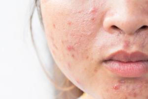 acne | image credit: frank29052515 - stock.adobe.com