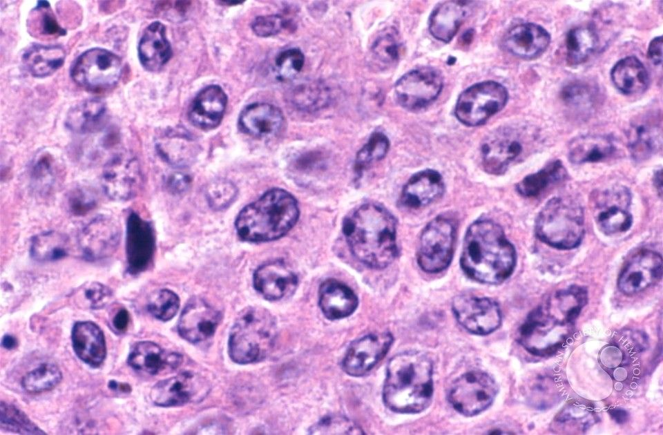 DLBCL | Image: Marshall Kadin/ASH Image Bank