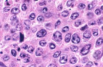 DLBCL | Image: Marshall Kadin/ASH Image Bank