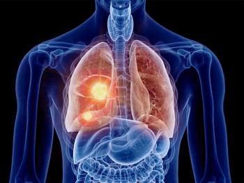 Lung cancer illustration | Image credit: SciePro - stock.adobe.com