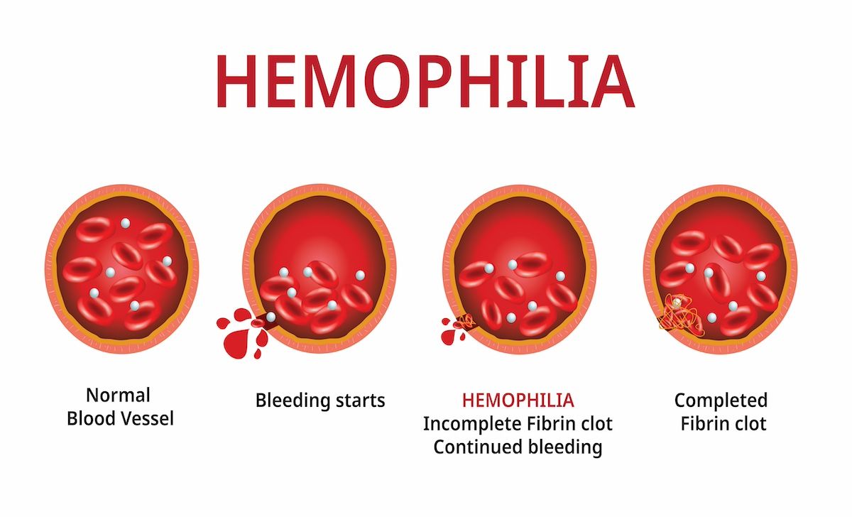 hemophilia damage | Image Credit: Akarat Phasura-stock.adobe.com
