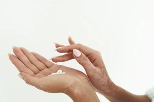 By week 12 of treatment with ruxolitinib cream, the majority of patients with nonsegmental vitiligo experienced significant repigmentation. | Image credit: etonastenka - stock.adobe.com