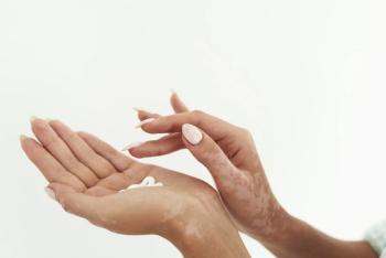 By week 12 of treatment with ruxolitinib cream, the majority of patients with nonsegmental vitiligo experienced significant repigmentation. | Image credit: etonastenka - stock.adobe.com