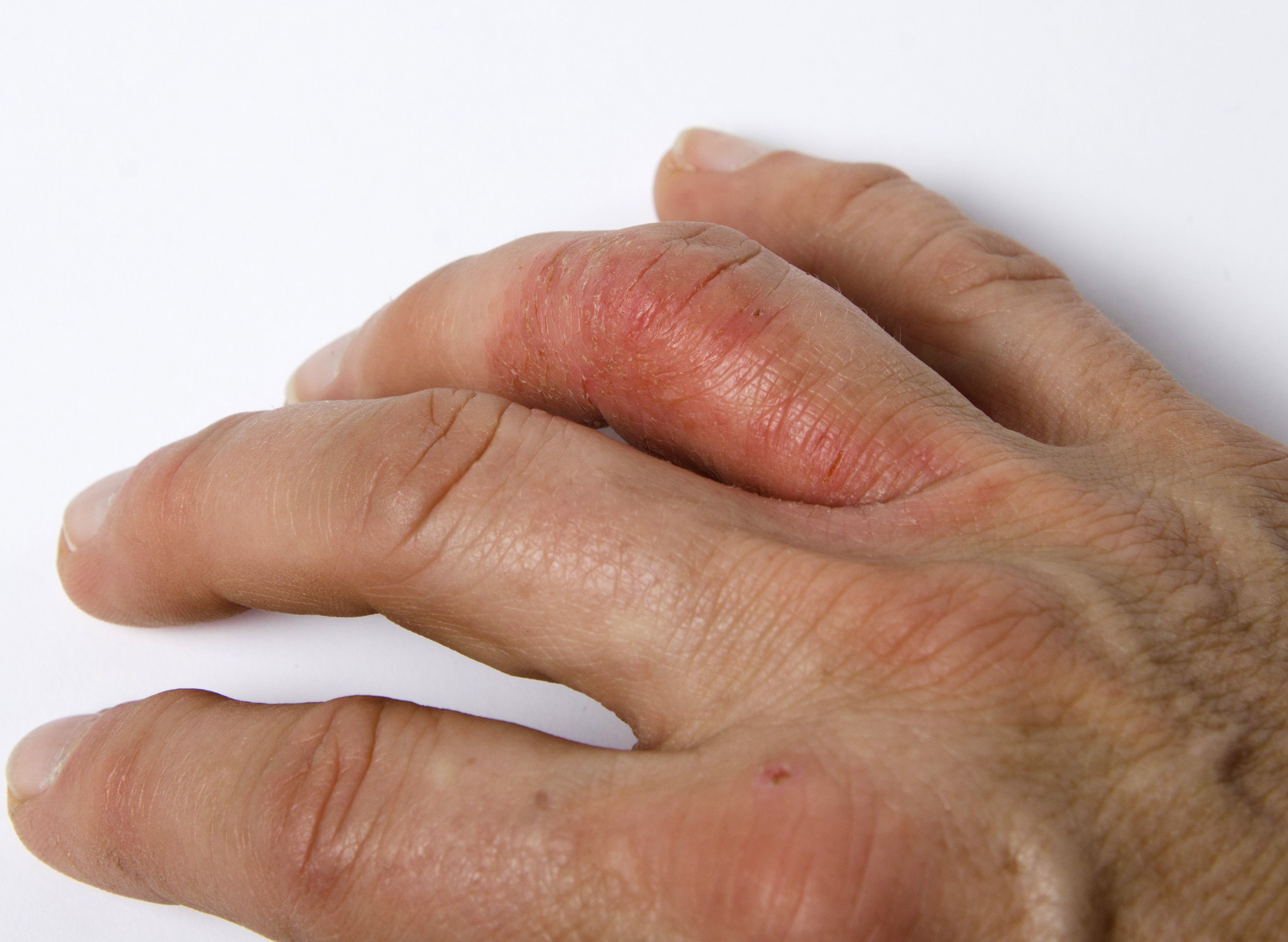 Real-World Study Illustrates Secukinumab’s 24-Month Performance for Psoriatic Arthritis