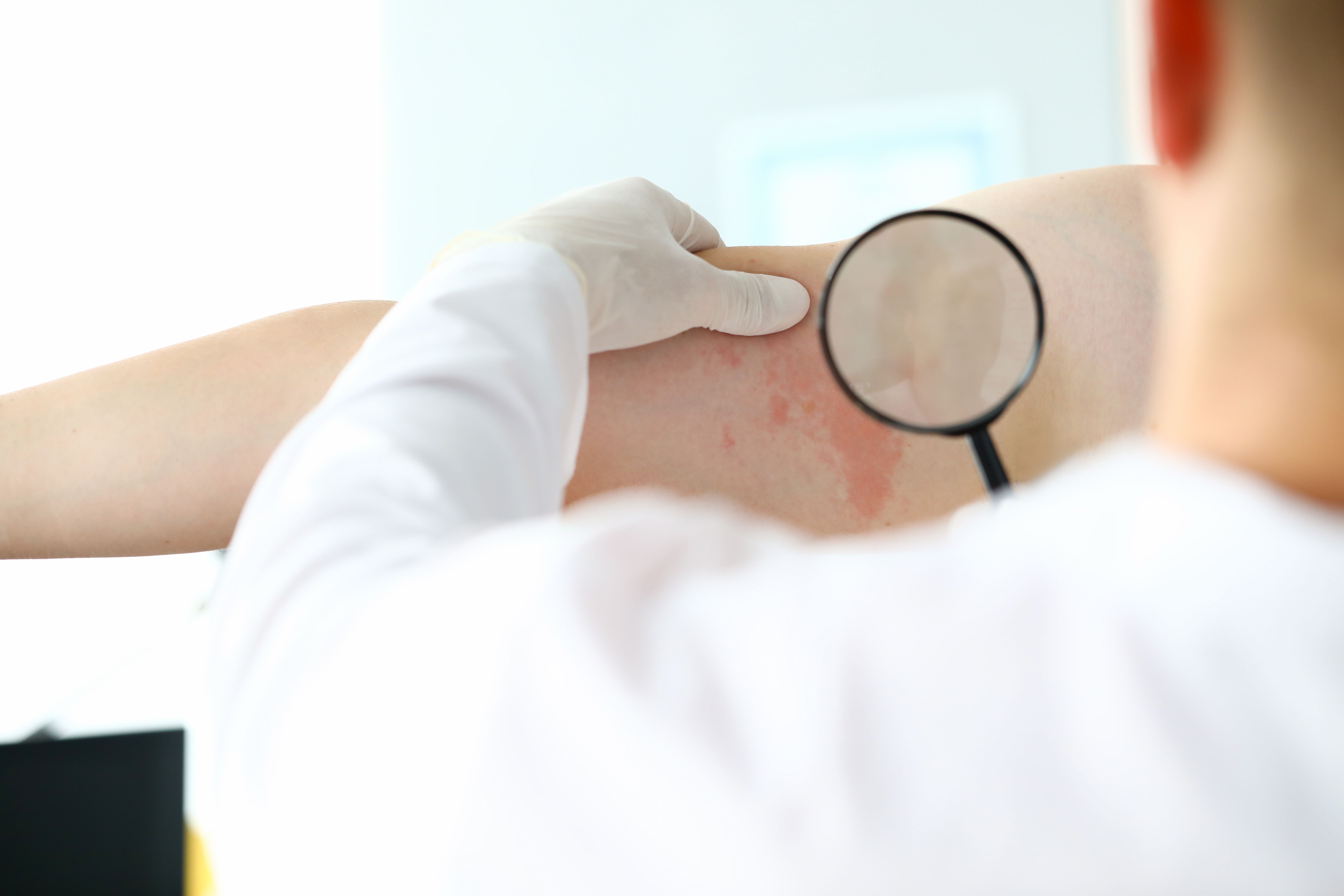 Dermatite atopique, inflammation systémique non liée au risque de démence