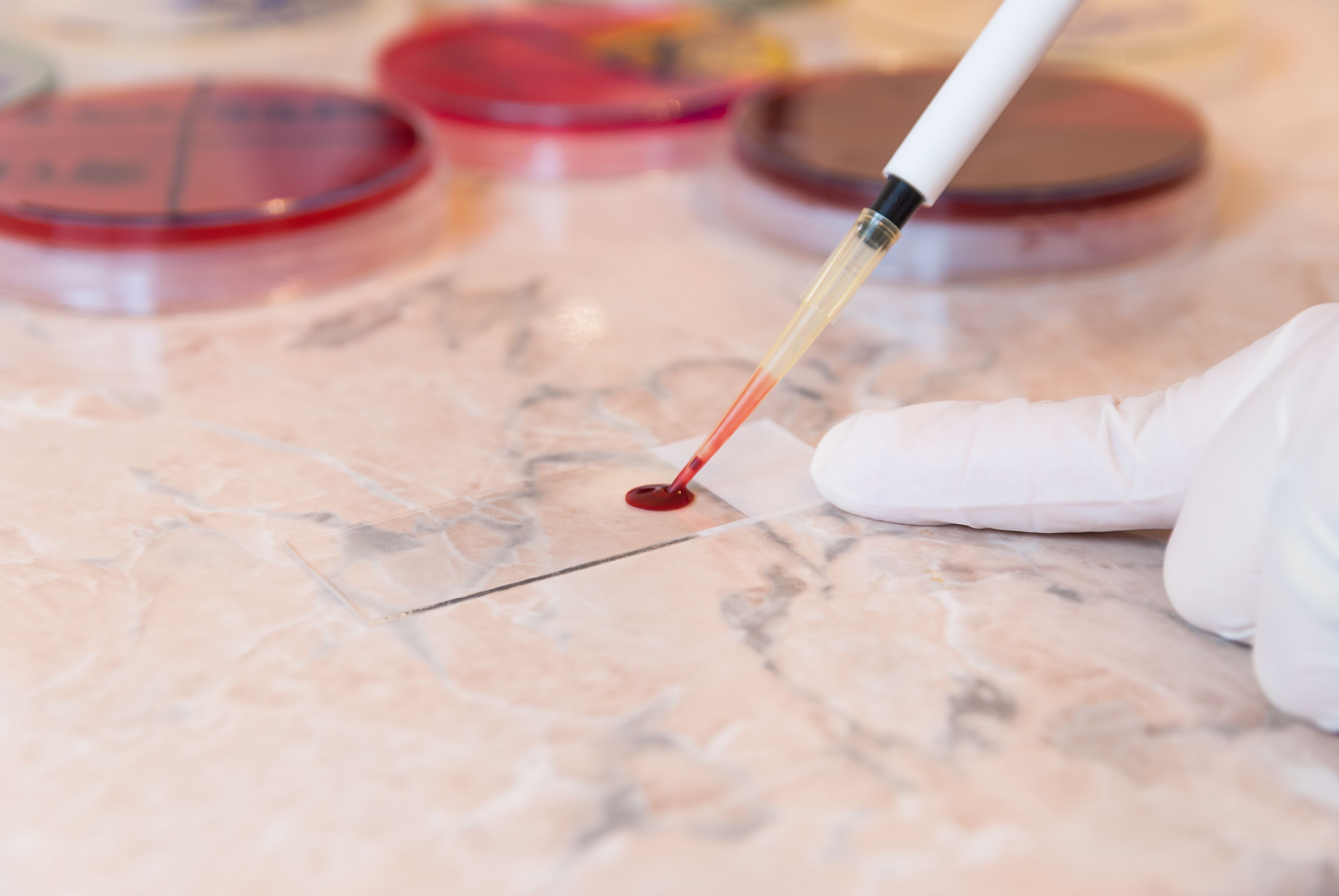 Licensed doctor or scientific researcher preparing for a smear test or blood film. Using a pipette the doctor will put a drop of blood on the sterile slide | Image Credit: raresb – stock.adobe.com