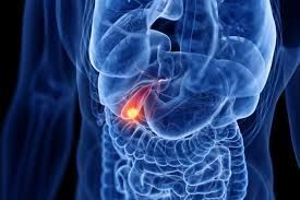 Image of bile duct cancer