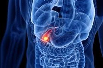 Image of bile duct cancer