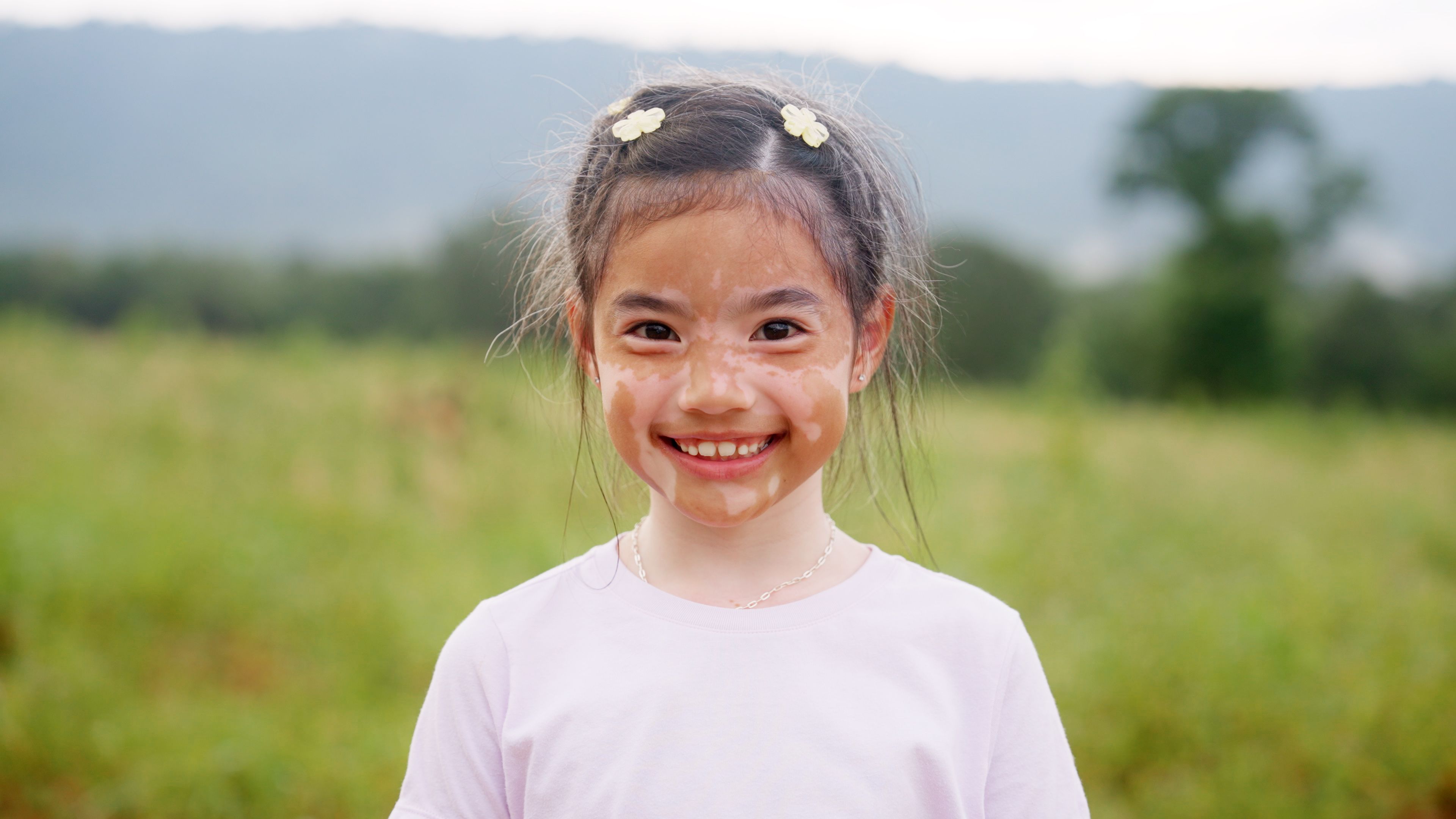 Child with vitiligo | Image credit: ChayTee - stock.adobe.com
