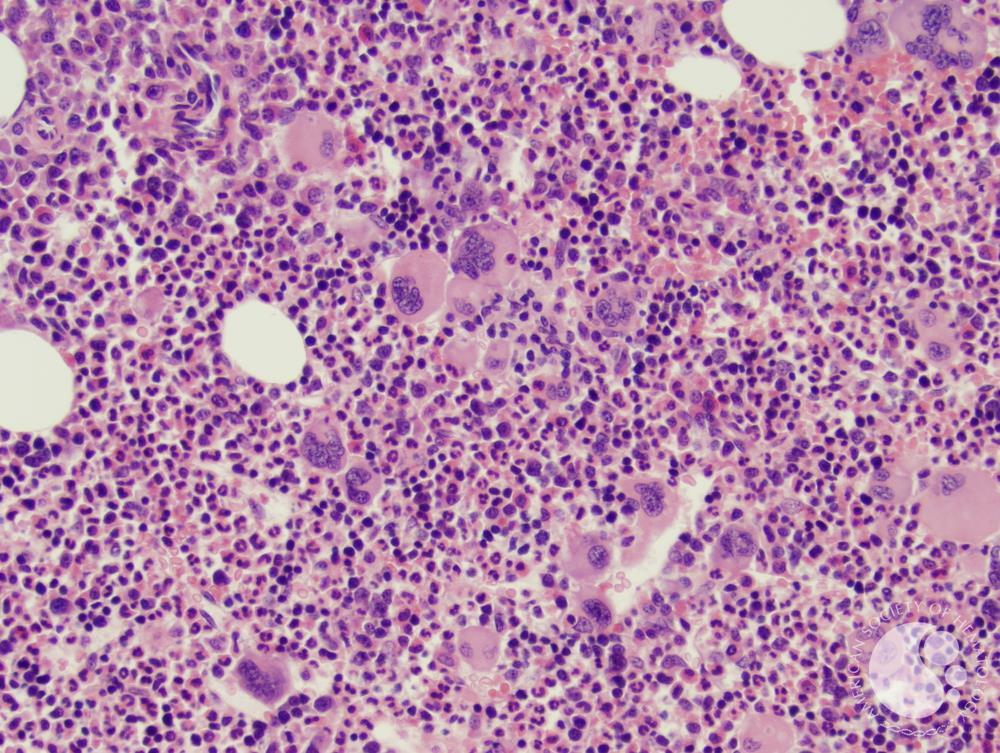 Polycythemia Vera | Image credit: Elizabeth L. Courville, MD, for ASH Image Bank