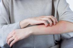 Woman scratching skin | Image credit: Monstar Studio - stock.adobe.com