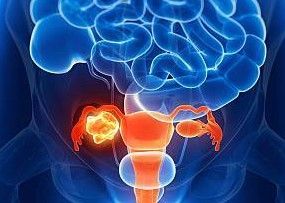 Recent Adavosertib Results in Ovarian Cancer Could Be Sign of Things to Come