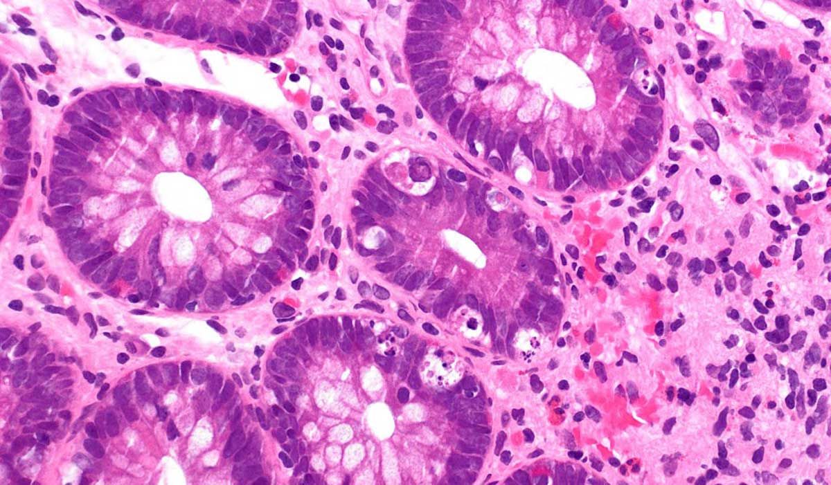 Image of graft-versus-host-disease