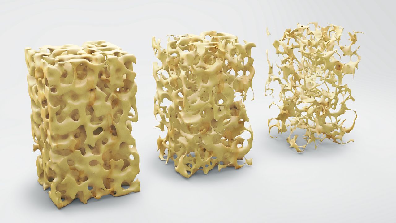 Image of bones with osteoporosis: adimas - stock.adobe.com