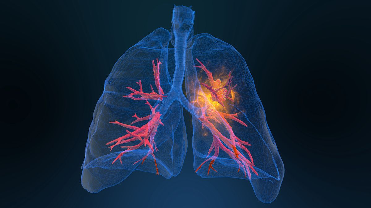 Lung cancer 3D | Image Credit: © appledesign - stock.adobe.com