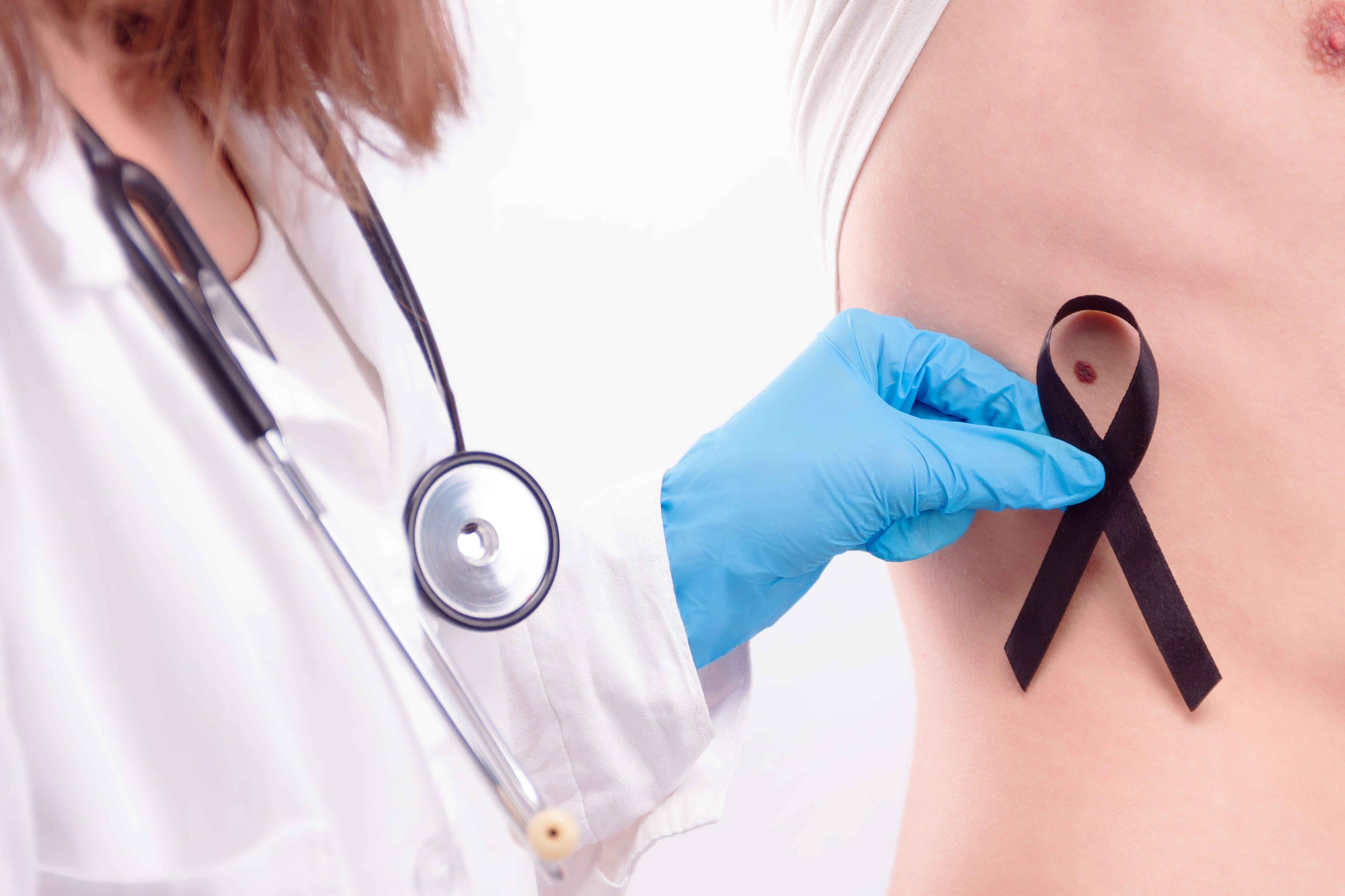 Skin cancer checkup concept with cancer ribbon | image credit: Monstar Studio - stock.adobe.com