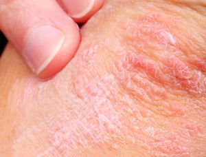 Level of QOL Impact of Psoriasis Does Not Appear to Be Influenced by Affected Body Region