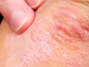 closeup of psoriasis