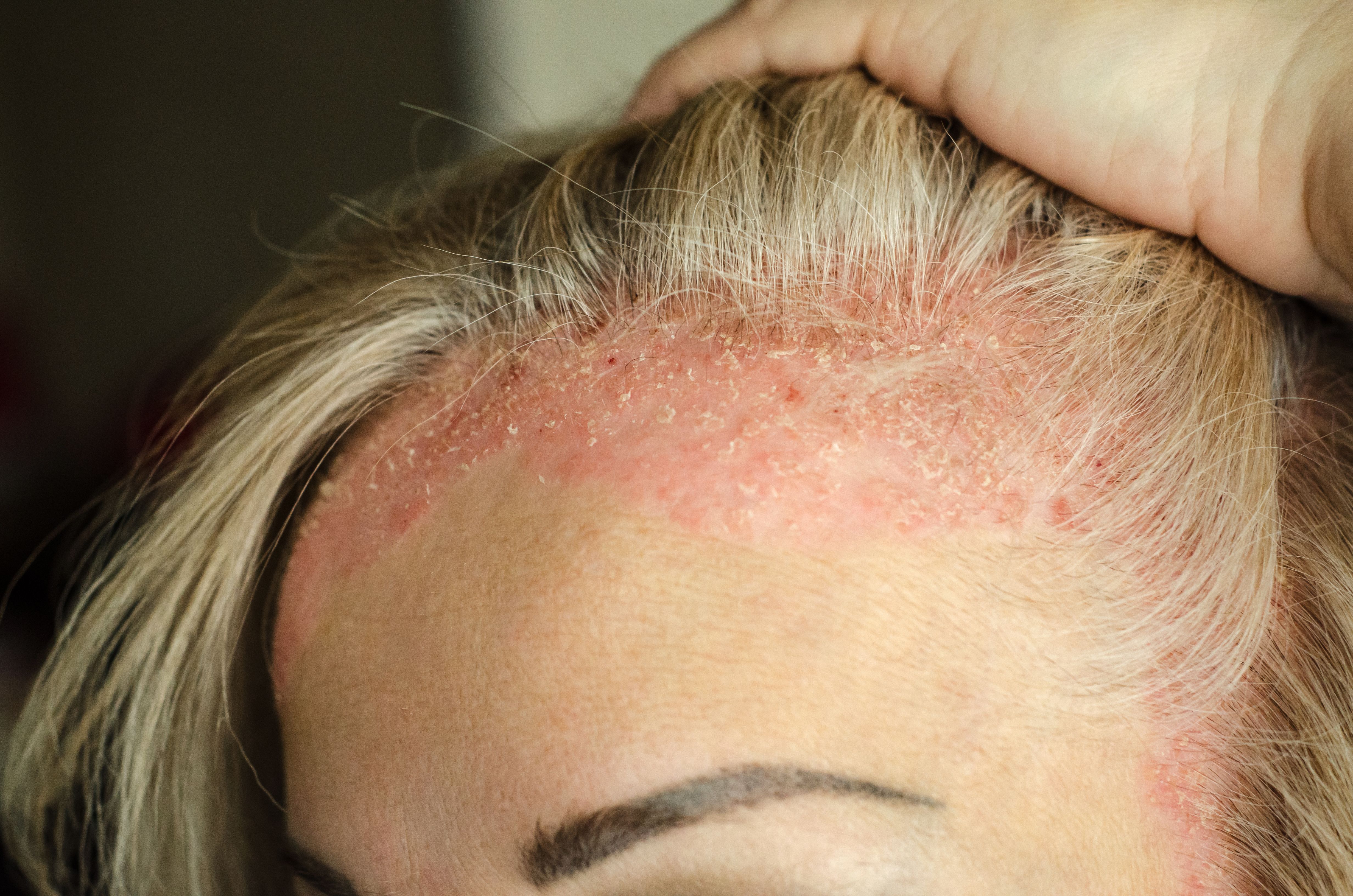 Psoriasis | Image Credit_ Егор Кулинич - stock.adobe.com
