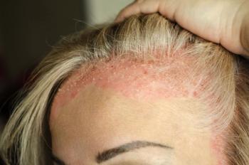 Psoriasis | Image Credit_ Егор Кулинич - stock.adobe.com