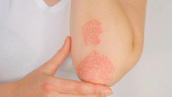 CLOSE UP Woman with big red scaly rash suffering from elbow psoriatic arthritis: © helivideo - stock.adobe.com
