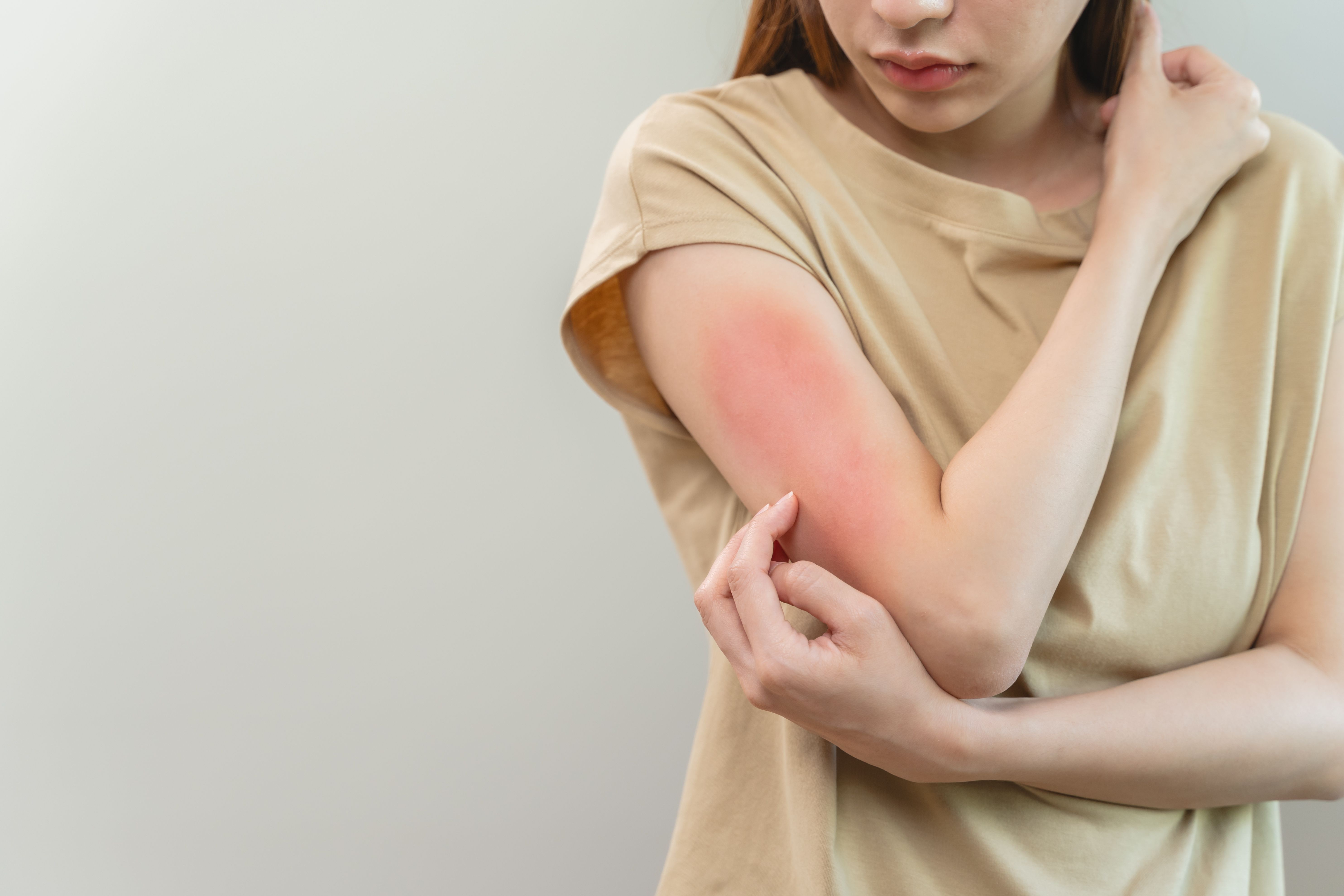 Atopic Dermatitis Itch. | Image Credit:  Pormezz - stock.adobe.com 