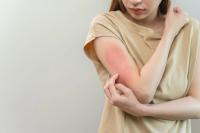 Atopic dermatitis itch on woman's arm. | Image Credit:  Pormezz - stock.adobe.com .jpeg