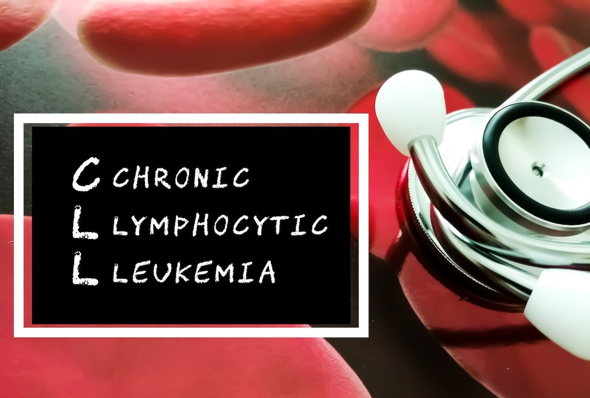 Chroniclymphocyticleukemia | Image Credit: © Saiful52-stock.adobe.com