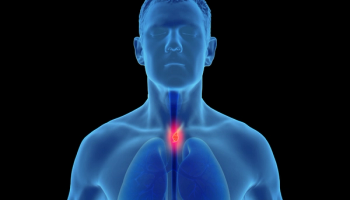 Esophageal cancer