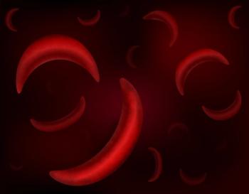 Image of sickled cells
