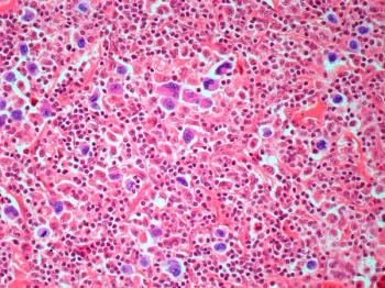 Muscle Loss in Immunochemotherapy for DLBCL