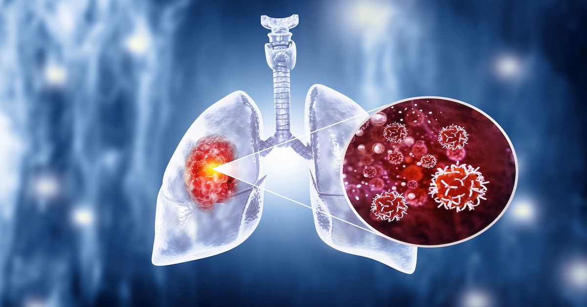 Medical Illustration showing lung cancer | Image Credit: Crystallight-stock.adobe.com