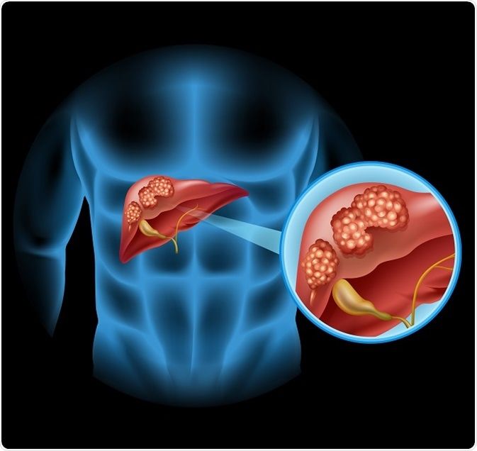 bile duct cancer