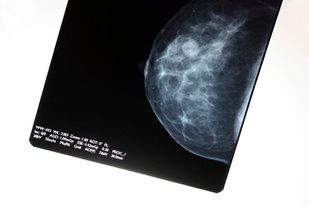 What We're Reading: Mammogram Guidelines Update; Weaning Patients off Opioids; New York Measles Outbreak