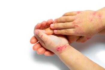 Child's hand with psoriasis | Imaged credit: Ruslan Ivantsov - stock.adobe.com