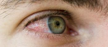 Red, irritated eye