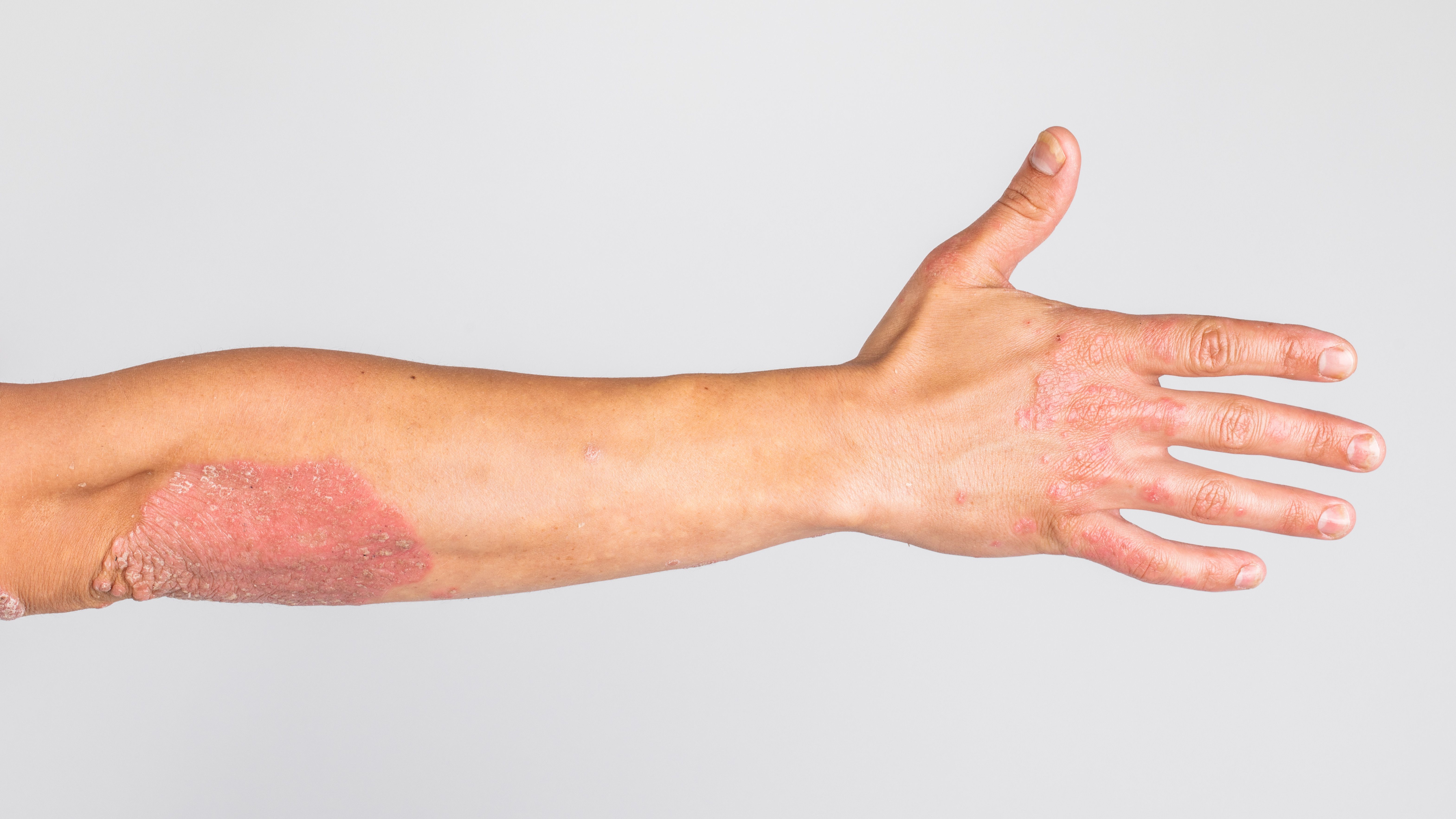 Psoriasis | Image credit: fusssergei - stock.adobe.com
