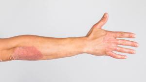 Tildrakizumab Shows Long-Term Psoriasis Control for Hard-to-Treat Areas