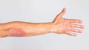 Psoriasis | Image credit: fusssergei - stock.adobe.com