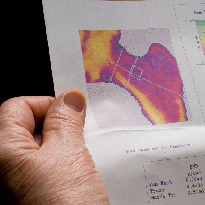 Links Seen Between Nonalcoholic Fatty Liver Disease and Increased Bone Loss, Osteoporosis