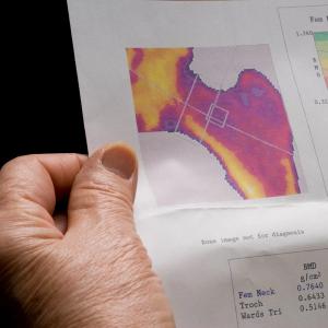 Preventing Costly Bone Fractures - Why Don't We Do What Works?