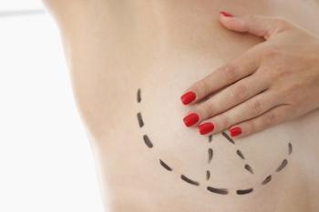 Patient satisfaction was higher amongst women who underwent chest wall perforator flap technique when compared with other techniques.| Image Credit: AdobeStock_ H_Ko.jpeg
