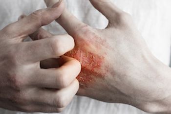 Psoriasis