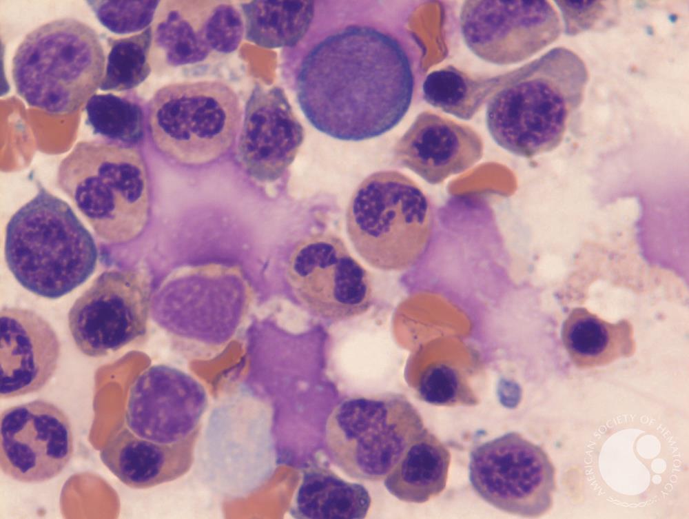 MDS with ring sideroblasts | Girish Venkataraman, MD, MBBS; ASH Image Bank