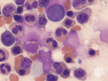 MDS with ring sideroblasts | Girish Venkataraman, MD, MBBS; ASH Image Bank